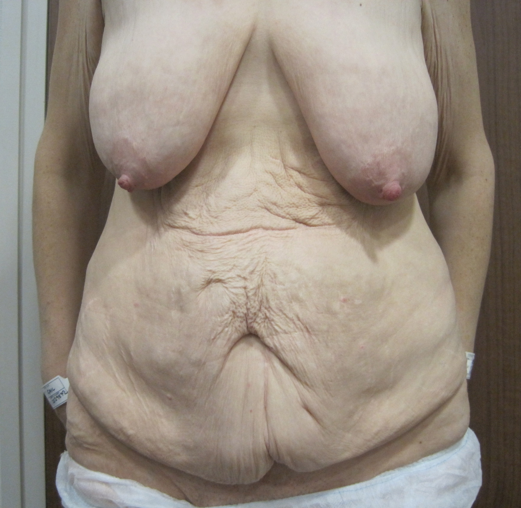 Bodyshockers' ex-Hooters barmaid has her FF breast implants