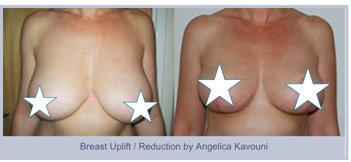 Breast reduction  Ms Angelica Kavouni Cosmetic Plastic Surgeon
